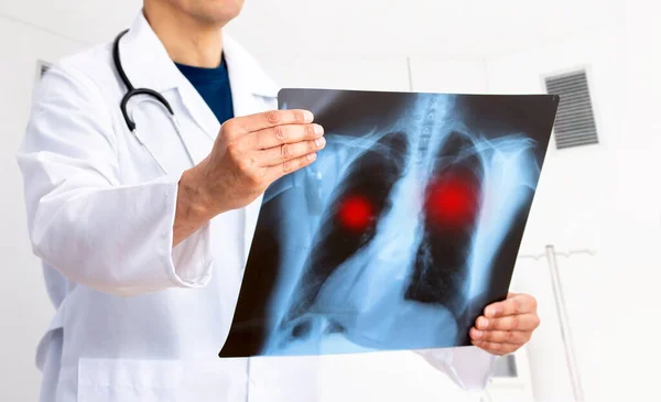 Lung Cancer Pneumonia Doctor Check Ray Image Have Problem Lung — Stockfoto