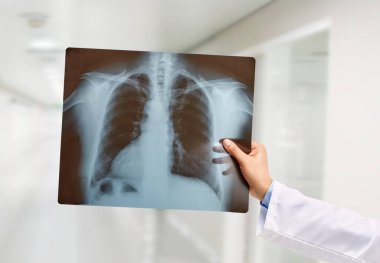 Man hand holding a lungs radiography at hospital