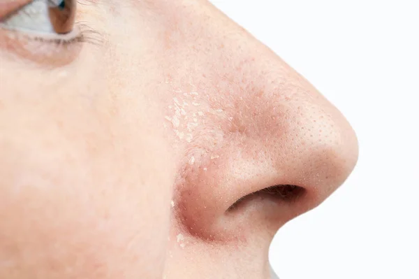 Wanita Dengan Gejala Dermatitis Atopik Hidungnya — Stok Foto