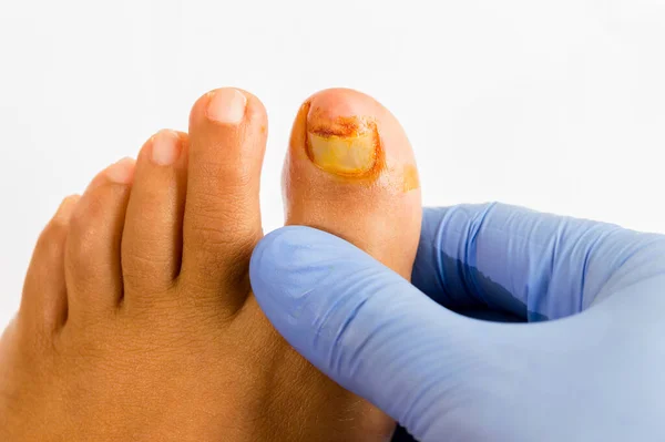 부러진 손톱으로 발가락을 제어하는 의사의 모습을 클로즈업 — 스톡 사진