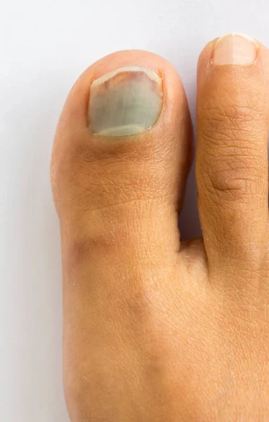Close Subungual Hematoma Blue Black Toe Nail — Stock Photo, Image