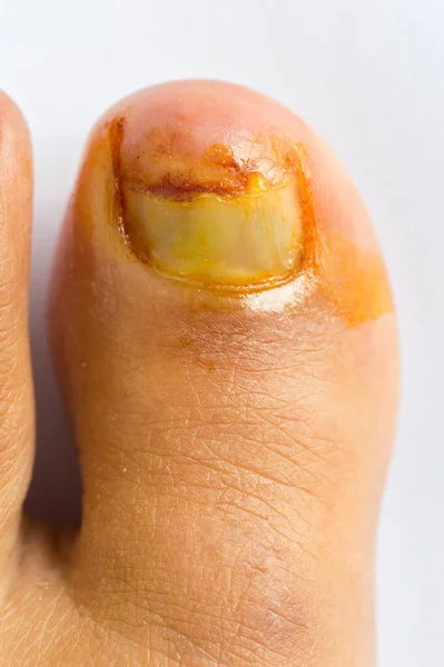 左脚趾在事故中受伤 是红肿的易燃物 骨折的指甲是在白底隔离的情况下重新出生的 — 图库照片