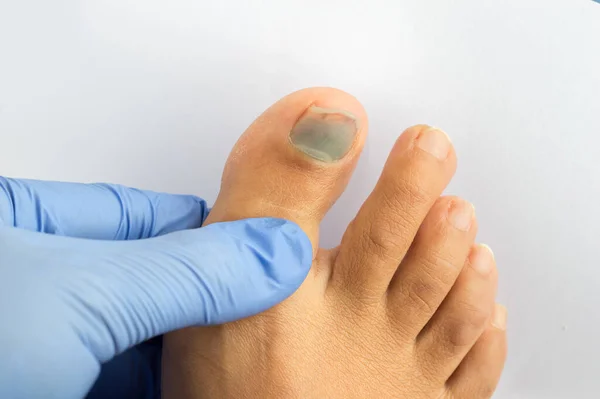 의사가 아래측 파란색 과검은 발가락 손톱으로 고통받고 확인하고 모습을 — 스톡 사진