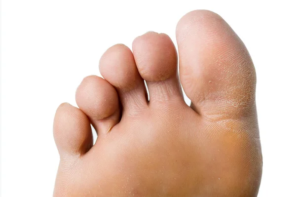 Nahaufnahme Des Fußes Einer Frau Mit Trockener Und Verhärteter Haut — Stockfoto