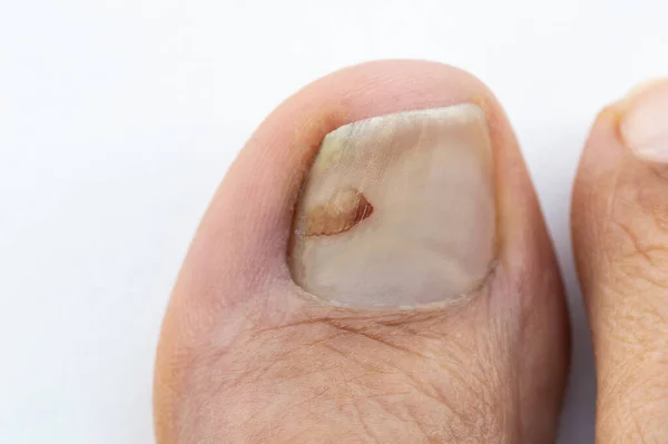 Висококутний Знімок Пальця Оніхомікоз Грибковою Інфекцією Нігтів Ізольовано Білому — стокове фото