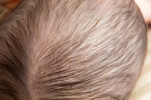 Newborn Baby Psoriasis Dandruff Hair — Zdjęcie stockowe