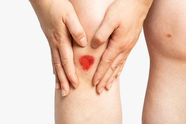 Close Woman Legs Looking Her Bloody Wound White Background — Stock Photo, Image