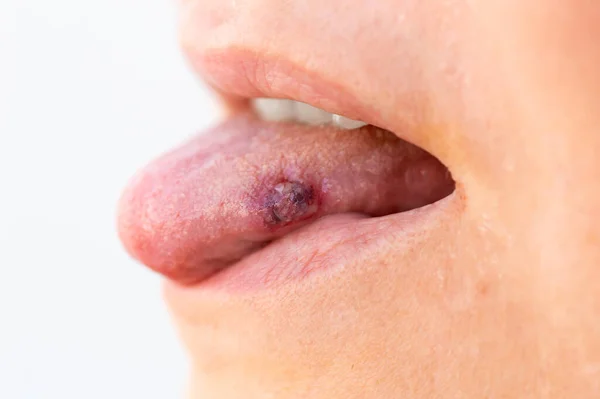 Fechar Língua Com Úlceras Mulher Adulta — Fotografia de Stock