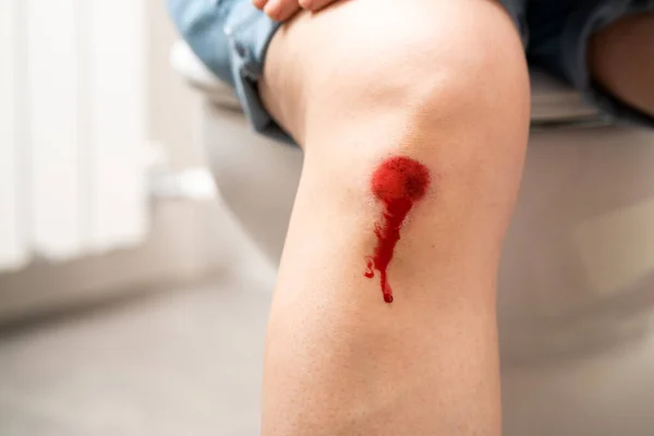 Fechar Perna Uma Mulher Com Uma Ferida Sangrenta — Fotografia de Stock