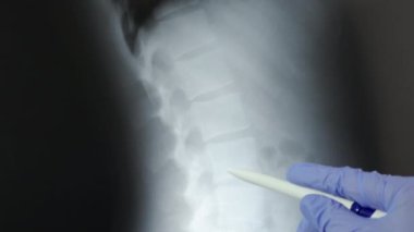 Doktor, omurgayı röntgenle radyolojik olarak analiz ediyor. Doktorun eldiveni inceler ve etkilenen bölgeyi işaret eder..