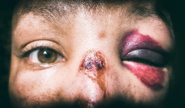 Концепция Домашнего Насилия Женщина Чёрным Глазом Шайнер После Боя Человеком — стоковое фото
