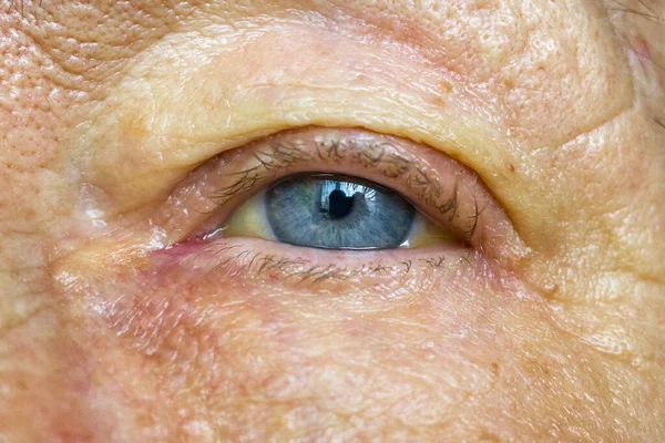 close up shot of yellowed eyes and yellow skin of patient with jaundice. severe form of Hepatitis. medical concept.