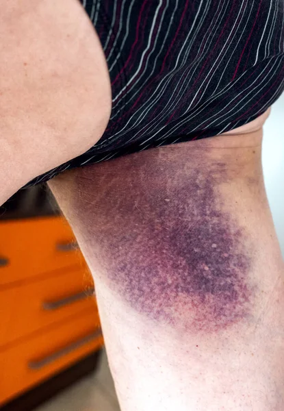 Bruise on the leg of a man. A bruised thig. Close-up.