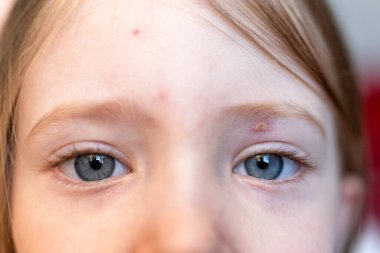 Varicella virüsü ya da çocuk üzerinde suçiçeği kabarcıkları.