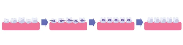 Prozess Der Zahnbegradigung Mit Zahnspangen Flache Vektordarstellung Isoliert Auf Weißem — Stockvektor