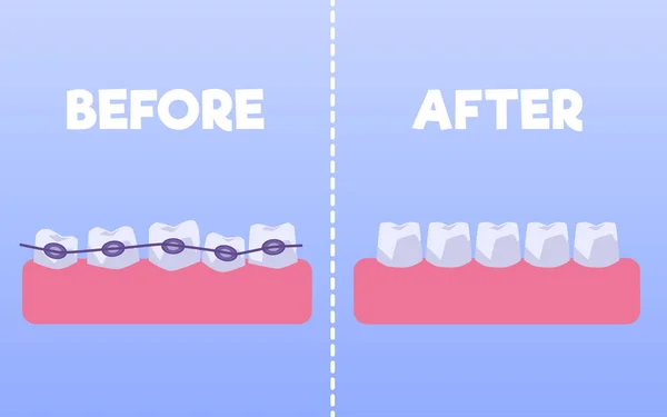 Teeth Braces Flat Style Vector Illustration Isolated Blue Background Alignment — Stockvector