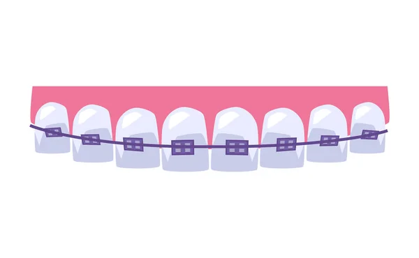 Prostowanie Zębów Fioletowymi Szelkami Dentystycznymi Płaska Ilustracja Wektora Izolowana Białym — Wektor stockowy