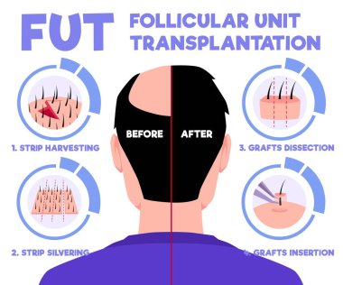 FUT saç nakli alopecia tedavisi 4 adım sonra. Foliküler birim nakil yenileme ameliyatının aşamaları. Klinikler için vektör bilgi grafikleri şablonu, daha sonra