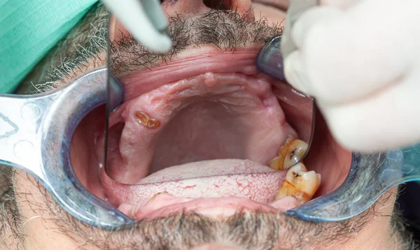 Diş Implantı Tasarımı Için Retraktörle Yapılan Inceleme Sırasında Çürük Dişler — Stok fotoğraf