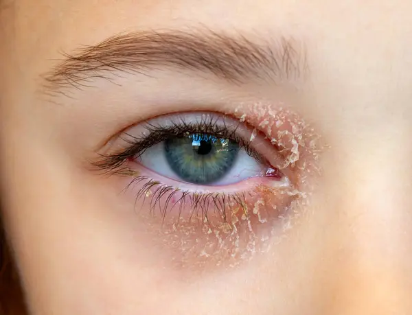 Auge Eines Kleinen Mädchens Das Okulärer Atopischer Dermatitis Oder Augenliderekzemen lizenzfreie Stockbilder