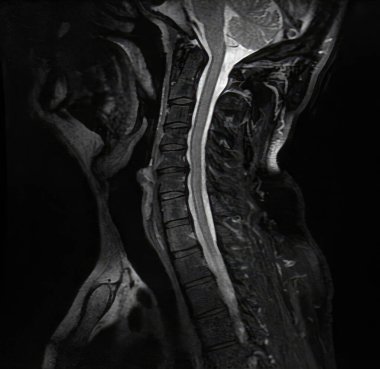 Servikal omurganın yay MRI taraması omuriliği vurguluyor ve yumuşak dokuları çevreliyor.