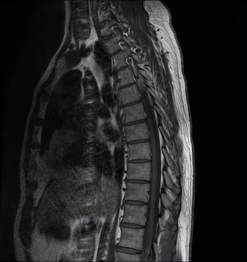 Göğüs ve bel omurlarının Sagittal MR taraması sağlıklı omurilik, omurilik, omurgalar, omurgalar arası diskler, kaburgalar, kalp ve akciğerler gösteriyor.