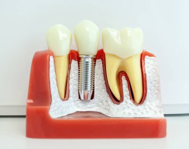 Diş implantı modelini kapatın. Çene kemiğine bir implant yerleştirildiğini gösterin. Sağlıklı dişleri ve diş etlerini vurgulayın.