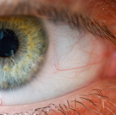 Göz bebekleri, göz bebekleri, göz sağlığı ve kılcal kırılganlık kavramlarıyla yeşil göz sklerasında görülen kan damarlarının aşırı yakınlaşması.