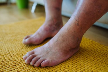 A close-up shot of mans feet with diabetic foot complications, showing his non-healing ulcers, skin discoloration and toe deformities. clipart