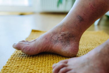 Erkek ayağının diyabetik ayak komplikasyonları, iyileşmeyen ülserlerini, deri renginin bozulmasını ve ayak parmaklarındaki deformasyonları gösteren yakın plan bir fotoğraf..