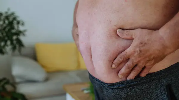 Close Shot Obese Man Holding His Belly Protruding Obese Abdomen Stock Picture