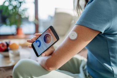 Sürekli glikoz monitörü kullanan diyabet hastası bir kadına yakın çekim. Şeker hastası bir kadın, CGM 'i akıllı telefona bağlayıp kan şekeri seviyesini eş zamanlı olarak ölçüyor..