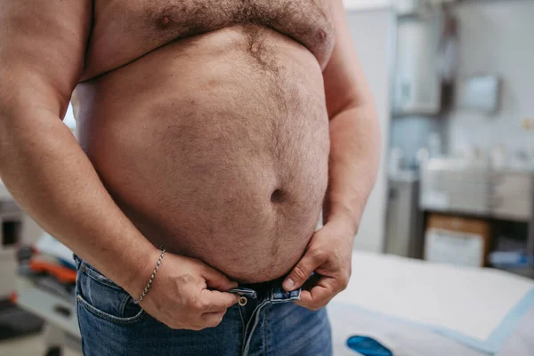 Close Abdomen Overweight Patient High Waist Circumference Obese Man Concept — Stock Photo, Image