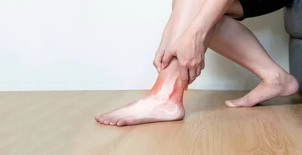 stock image Inflammation of the ankle bones a human