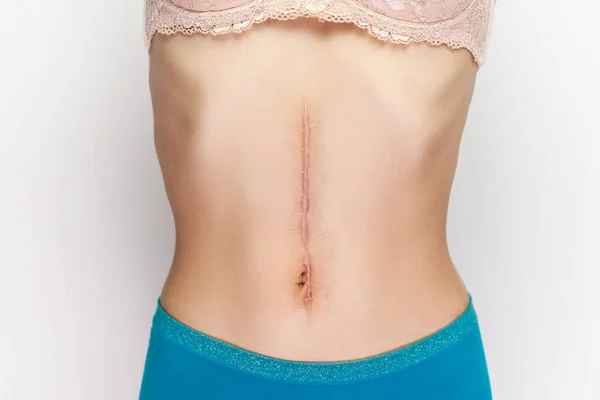 Closeup Portrait Young Woman Large Scar Surgery Abdomen Naked Belly — Stock Photo, Image