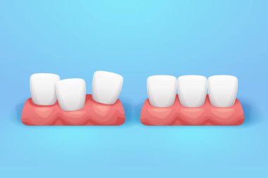 Mavi arkaplanda diş etlerinin üzerindeki parlak düz ve eğri dişlerin çizimi