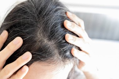 Prematüre gri saç problemi, saç dökülmesi, tiroid veya otoimmün bozukluğu, alopecia areata, vitamin eksikliği, gri saç, sağlık, tıbbi konsept gibi konularda endişeli Asyalı genç kadın.