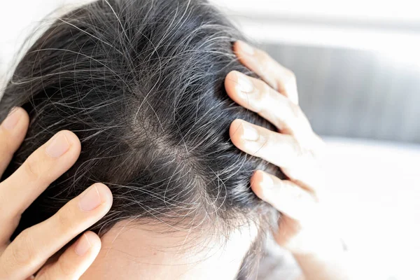 Premature gray hair problem,stressed asian young woman with hair loss,thyroid or autoimmune disorders,alopecia areata,deficiency of vitamins,concerned about graying hair,health care,medical concept