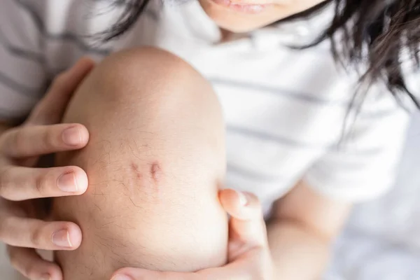 Stressed teenager girl with Hypertrophic scar,experiencing scar problem,concern about keloid scar on skin at knee after a fall or injury from an accident,wound care,healing,medical treatments concept