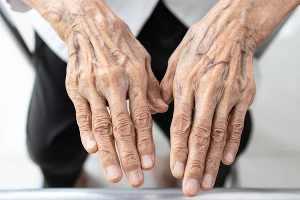 Mulher Idosa Velha Mostrando Mãos Enrugadas Abaulamento Veia Parte Trás — Fotografia de Stock