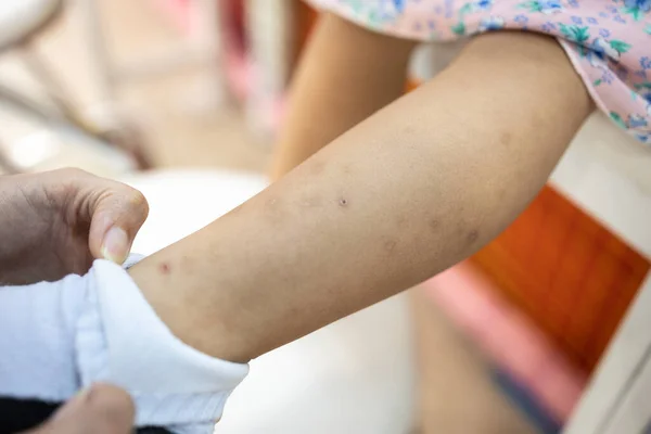Κοριτσάκι Ουλές Μελαχρινές Κηλίδες Στο Πόδι Από Αλλεργία Στα Κουνούπια Εικόνα Αρχείου
