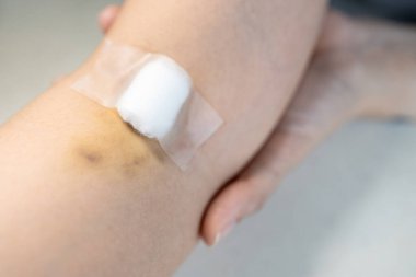 Yakın çekim, kan örneği, yara için alçı ve pamuk aldıktan sonra eklem yerlerinde çürük olan kadının kolu, kol ağrısı, kan testi, sağlık kontrolü, kan bağışı...