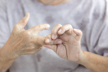 Romatizma, romatizma, romatizma hastalığına benzeyen son sınıf öğrencisi bir kadının parmaklarında ağrı, iltihap ve eklem sertliği, fiziksel acı, sağlık, tıbbi bakım gibi hastalıklar var.