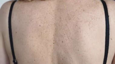 Olgun bir kadın cildinde yaş lekeleri var. Dermatoloji kozmetik problemi. Yüksek kalite 4k görüntü
