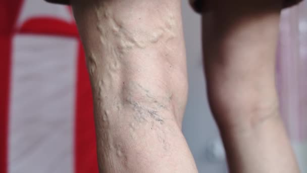 Dojrzała Kobieta Nogi Zbliżenie Żylaków Problem Wysokiej Jakości Materiał — Wideo stockowe