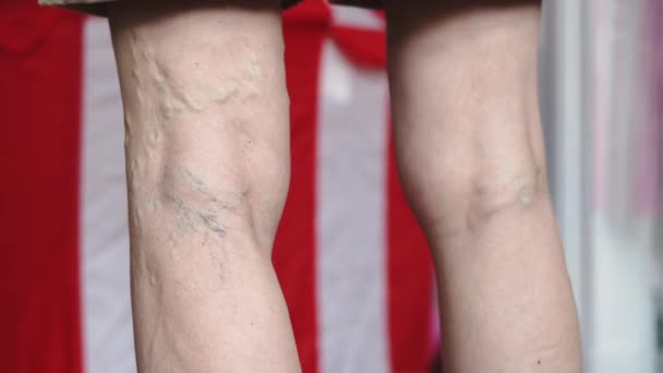 Picioarele Femeii Mature Apropie Probleme Venele Varicoase Imagini Înaltă Calitate — Videoclip de stoc