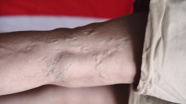 Olgun Kadın Bacaklarında Varis Sorunu Var Yüksek Kalite Görüntü — Stok video