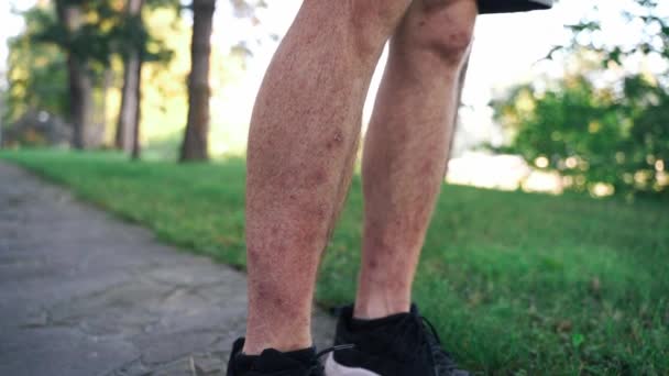Nahaufnahme Eines Männerbeins Mit Dermatitis Das Die Blasen Kratzt Rötung — Stockvideo