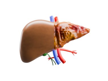 Sağlıklı bir karaciğer ve siroz için tıbbi 3 boyutlu karşılaştırma. İnsan hepatik organının anatomik çizimi. Yüksek kalite 3d illüstrasyon