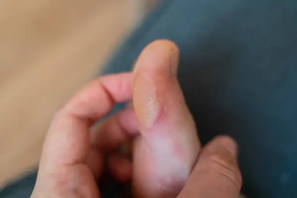 Close-up of a soft callus on a foot of a woman, sport shoes problem, corn on the leg. blister on the feet . High quality photo